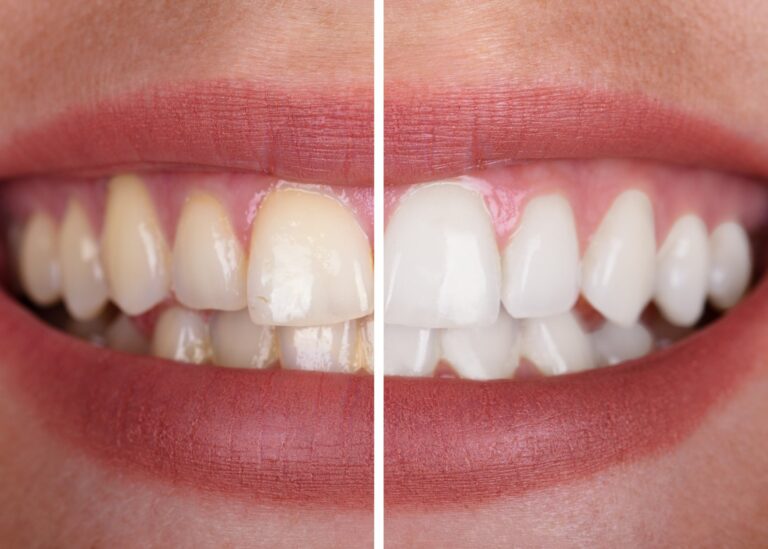 Teeth Whitening
