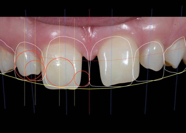 Smile Designing