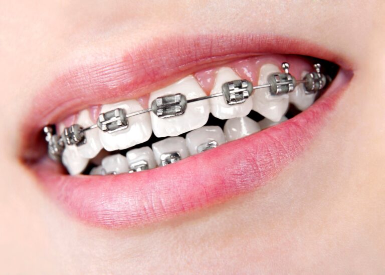 Fast Braces Treatment
