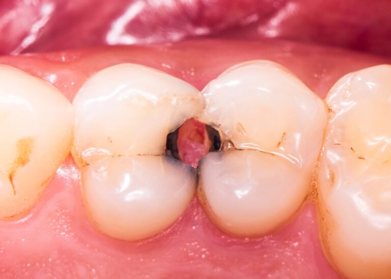 Teeth Cavities