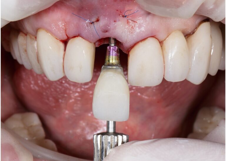 Dental Implants